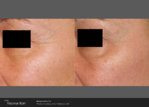Skin-Renewal-Before-_-After-Photo-1