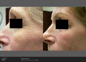 Skin-Renewal-Before-_-After-Photo-2