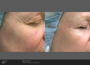 Skin-Resurfacing-Before-_-After-Photo-1