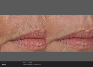 Skin-Resurfacing-Before-_-After-Photo-3