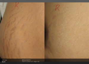 Stretch-Mark-Before-_-After-2_0