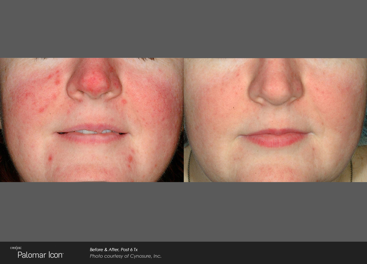 Skin-Revitalization-Before-&-After-Photo-6