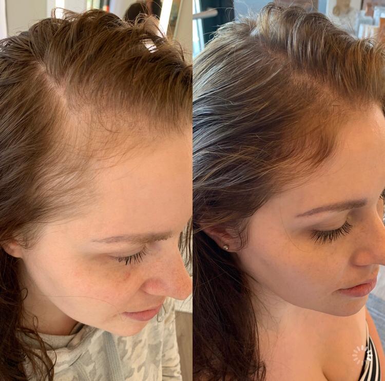10 JetPeel txs one per week with 2 steps and 30 minutes per treatment